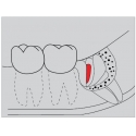 Surgery Diamond FGXXL G254 317 014 burs