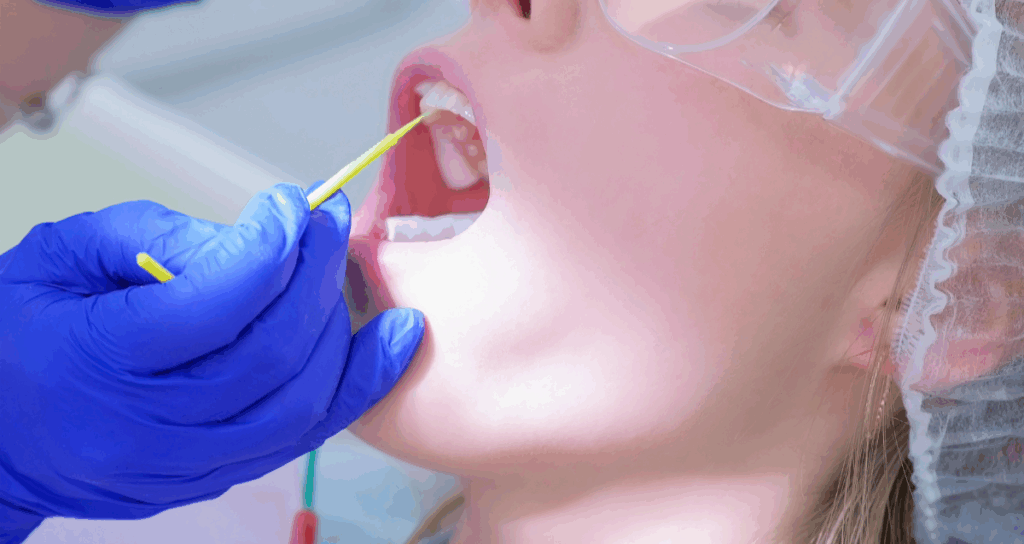 fluorizarea 